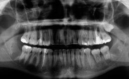 Panoramische röntgenopname direct postoperatief