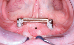 Peri-implantaire gezondheid bij 75-plussers met een overkappingsprothese op implantaten in de onderkaak