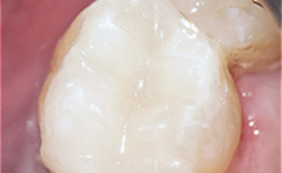 Endodontologie in beweging: nieuwe concepten, materialen en technieken 1. Hydraulische calciumsilicaatcementen
