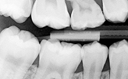 Endodontologie in beweging: nieuwe concepten, materialen en technieken 1. Hydraulische calciumsilicaatcementen