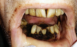 Geïnfecteerde necrose: donker verkleurde mucosa