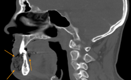 CT-beeld van geïnfecteerde necrose van de kin