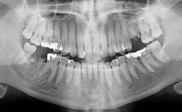 Panoramische röntgenopname van patiënt na 1,5 jaar geen tandartsbezoek