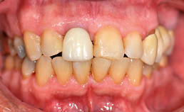 Frontaal aanzicht dentitie in occlusie
