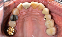 dentitie maxilla, occlusaal aanzicht