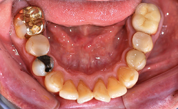dentitie mandibula, occlusaal aanzicht