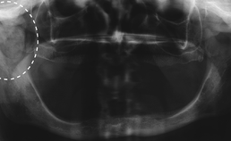 Jicht: panoramische röntgenopname