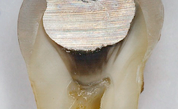Door amalgaam verkleurd dentineca