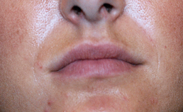 lippen voor aanbrengen siliconen lipimplantaat