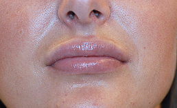 lippen na aanbrengen siliconen lipimplantaat