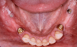 Implantaten in molaar- en premolaarregio