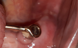 Tandsteen op linker implantaat, niet goed zichtbare matige peri-implantitis 