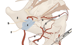 Hypothetische pathologische arteriële route van anestheticum