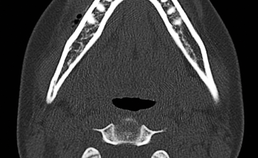 CT met radiolucente afwijkingen aan labiale zijde mandibula
