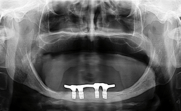 Röntgenopname met 4 implantaten van 6 mm lengte in een edentate onderkaak