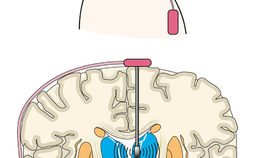 Met neurostimulator verbonden elektrode in de hersenen.