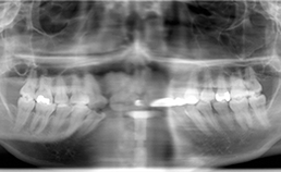 De tandheelkundige röntgenopname: valkuilen en verrassingen
