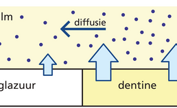 Schematische weergave van demineralisatie glazuur bij dentine