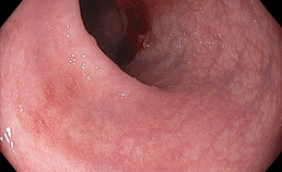milde vorm van colitis ulcerosa