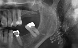 diffuse opake veranderingen dorsaal ramus mandibulae