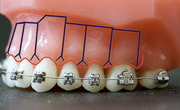 De versnelde orthodontische behandeling
