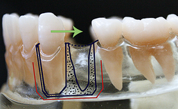 De versnelde orthodontische behandeling