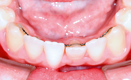 Gingivarecessies en orthodontie