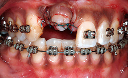 Autotransplantaten in plaats van implantaten? Het geheim van het parodontale ligament