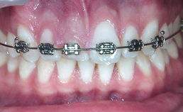 Orthodontische extrusie voorafgaand aan implantologie in de esthetische zone