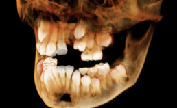 Interdisciplinaire orthodontisch-chirurgische behandeling van schisis van 9 tot 20 jaar