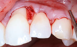 Gingivarecessies en parodontale plastische chirurgie