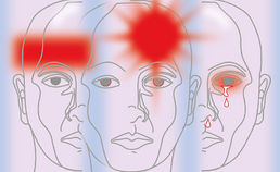 symptomen van 3 primaire hoofdpijnen