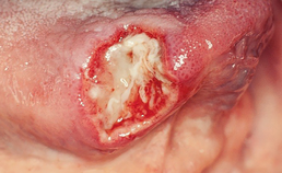 ulceratie tongrand door arteriitis lingualis