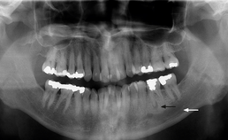 Periapicaal granuloom en verbrede canalis mandibularis