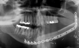 Reconstructie mandibula met fibulatransplantaat