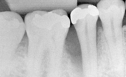 parodontaal defect tot bijna apicaal