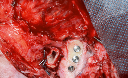 Implanteren van Cochlear Vistafix-implantaten
