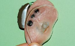 Oorprothese met gehoorapparaat