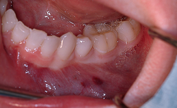 Pijnloze zwelling in premolaar/molaarstreek mandibula links