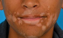 Periorale vitiligo