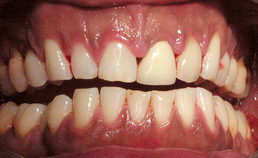 Hyperpigmentatie orale slijmvliezen