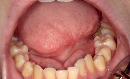 Orale automutilatie: een repetitief tongtrauma