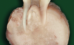 Cementoblastoom met radixresorptie en ingroei in pulpa