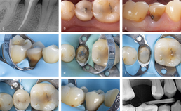 Endodontisch behandeld gebitselement 