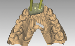 Digitaal design brug in maxilla