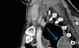 Sagittale coupe van CT-scan