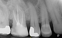 Intraorale röntgenopname na endodontischebehandeling