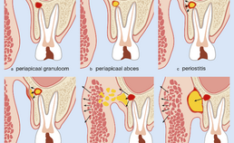 Verschillende fases van dentogene ontsteking