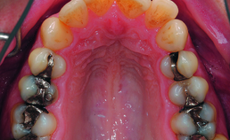 Intraorale opname maxilla vóór orthodontische behandeling