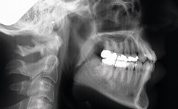 Initiële laterale röntgenschedelprofielopname